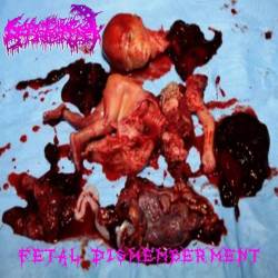 Fetal Dismemberment